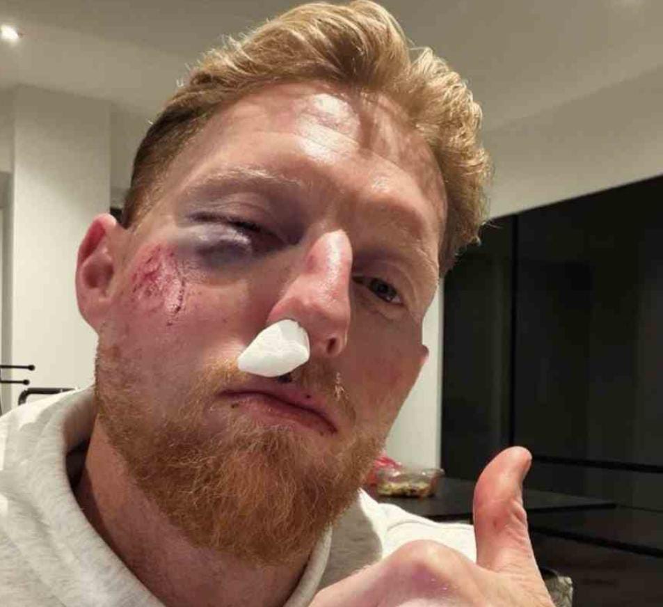 ভেঙেছে নাক , ফেটেছে গাল ঠোঁট , দুর্ঘটনার কথা জানালেন বেন স্টোকস