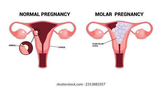 মাতৃত্বের পথে অজানা বিপদ: মোলার প্রেগন্যান্সি নিয়ে সচেতন হোন