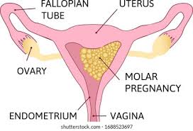 মাতৃত্বের পথে অজানা বিপদ: মোলার প্রেগন্যান্সি নিয়ে সচেতন হোন