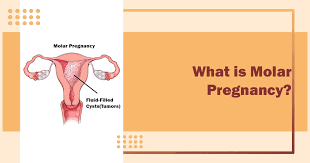 মাতৃত্বের পথে অজানা বিপদ: মোলার প্রেগন্যান্সি নিয়ে সচেতন হোন