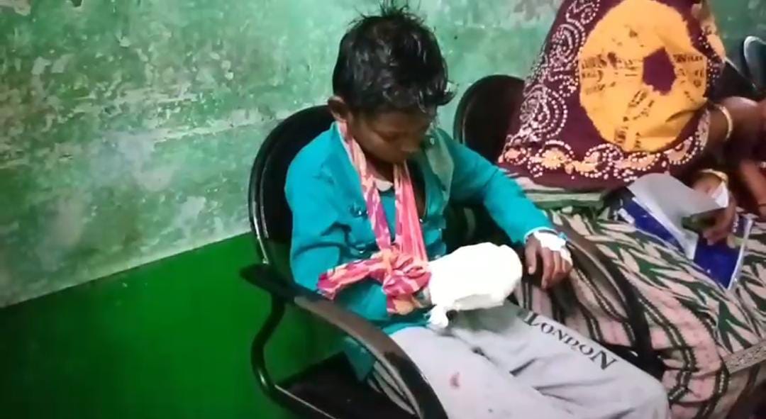 চকলেট বোমে আগুন ধরাতেই বিপত্তি , ডান হাত উড়ে গেল শিশুর