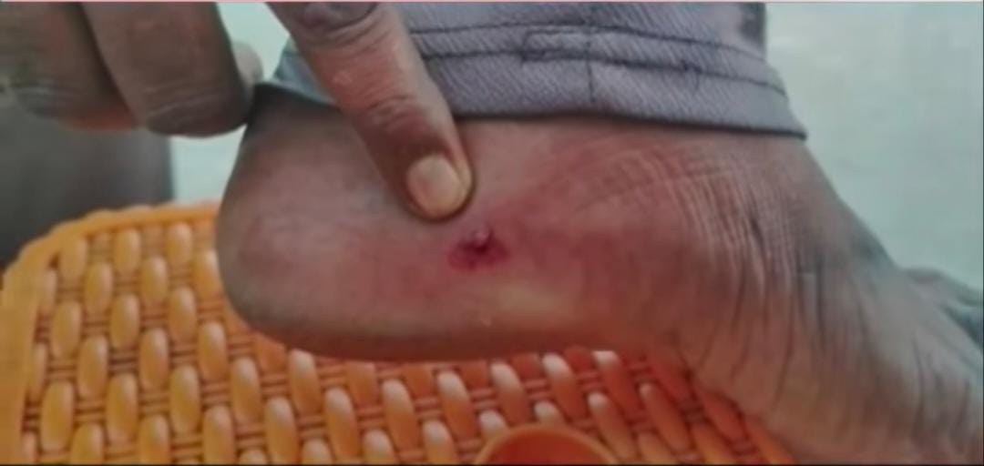 পথ কুকুরের কামড়ে আক্রান্ত ১০০ জন , বিপদে ফোন করলেও ধরছে না বন দফতর