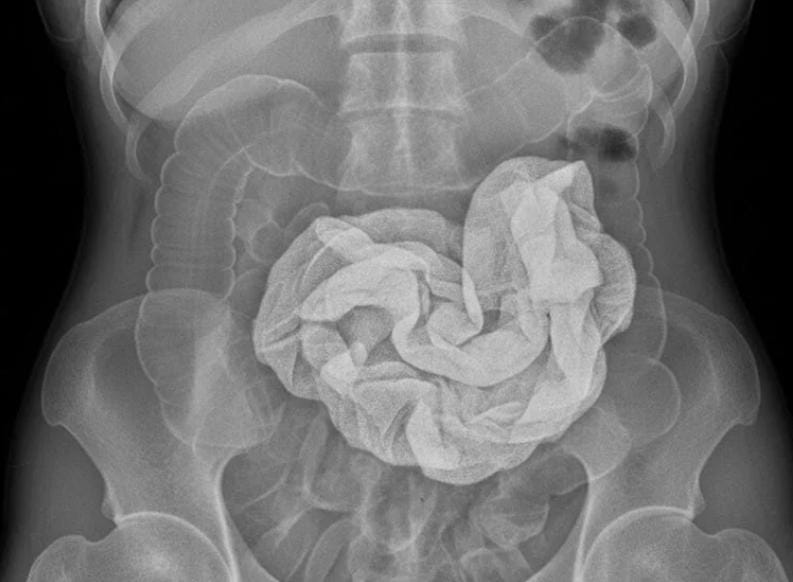 দেড় বছর ধরে পেটে হাফ মিটার কাপড় , চিকিৎসকের ভুলে জীবন নিয়ে টানাটানি মহিলার